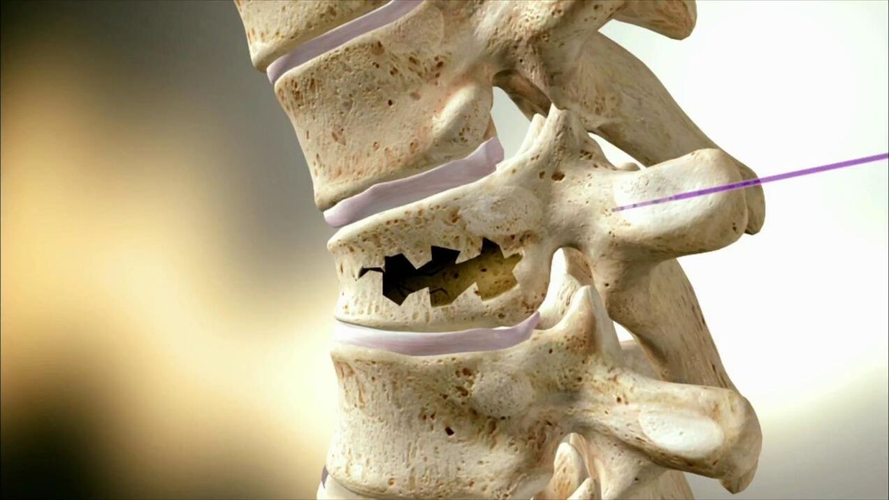 Disco de columna vertebral danado