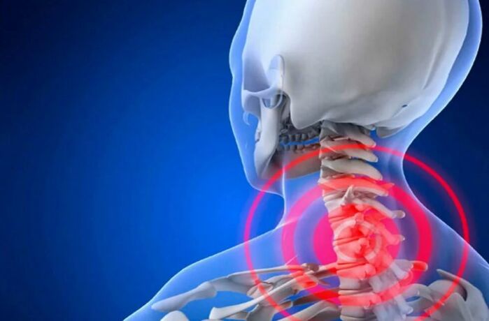 Osteocondrose da columna cervical